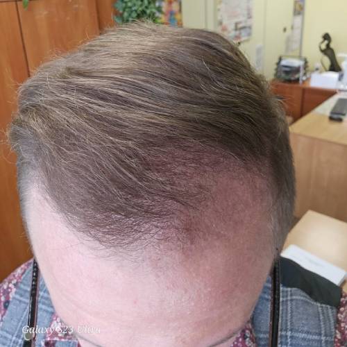 Full Recovery Period: Strengthening of New Hair Recovery Time