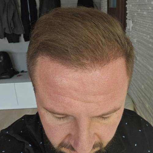 Hair Growth and Natural Appearance