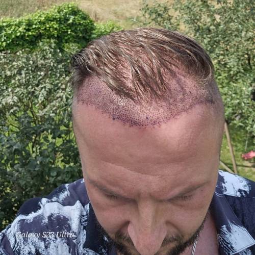 Initial Recovery Period: First Days and Weeks Mild Redness and Swelling 