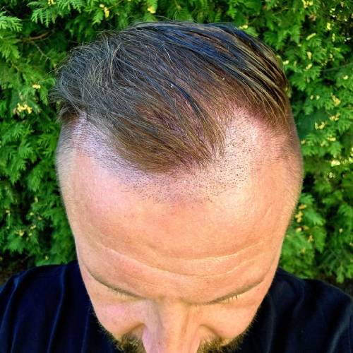 Shock Shedding (Temporary Shedding)