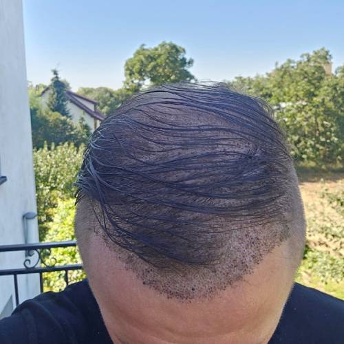 Post-Transplant Scab Shedding Phase