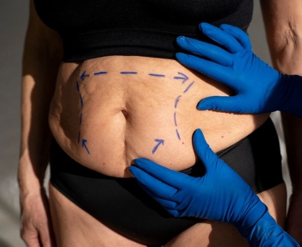 Liposuction is not recommended in the following situations: