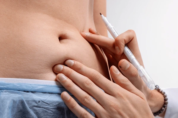 If you meet one or more of these criteria, you may be a candidate for liposuction: