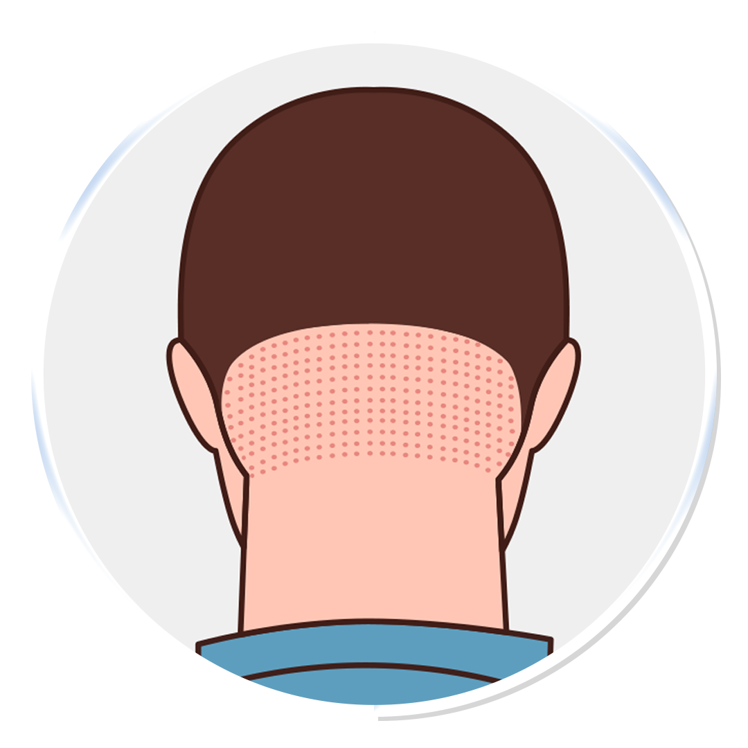 Stage 1 – Graft Harvesting