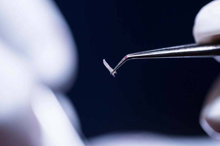 Hair Transplant with the FUE Vita Technique