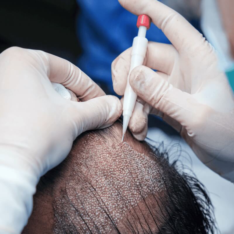 DHI Hair Transplant