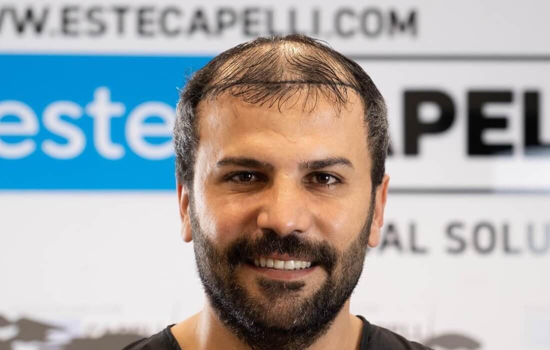 Before Treatment - Front