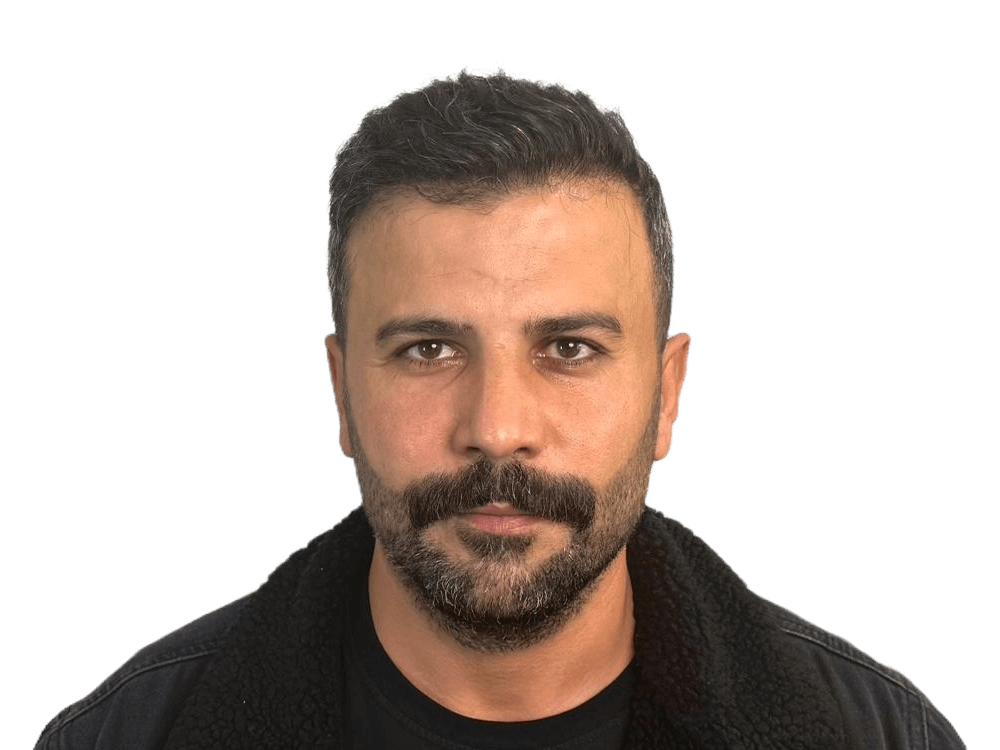 Hair Transplant Result