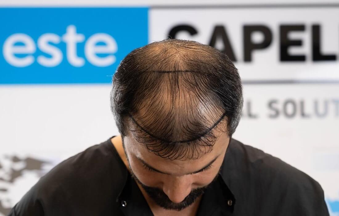 Before Treatment - Top