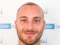 Before Treatment - Front