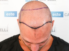 Before Treatment - Top