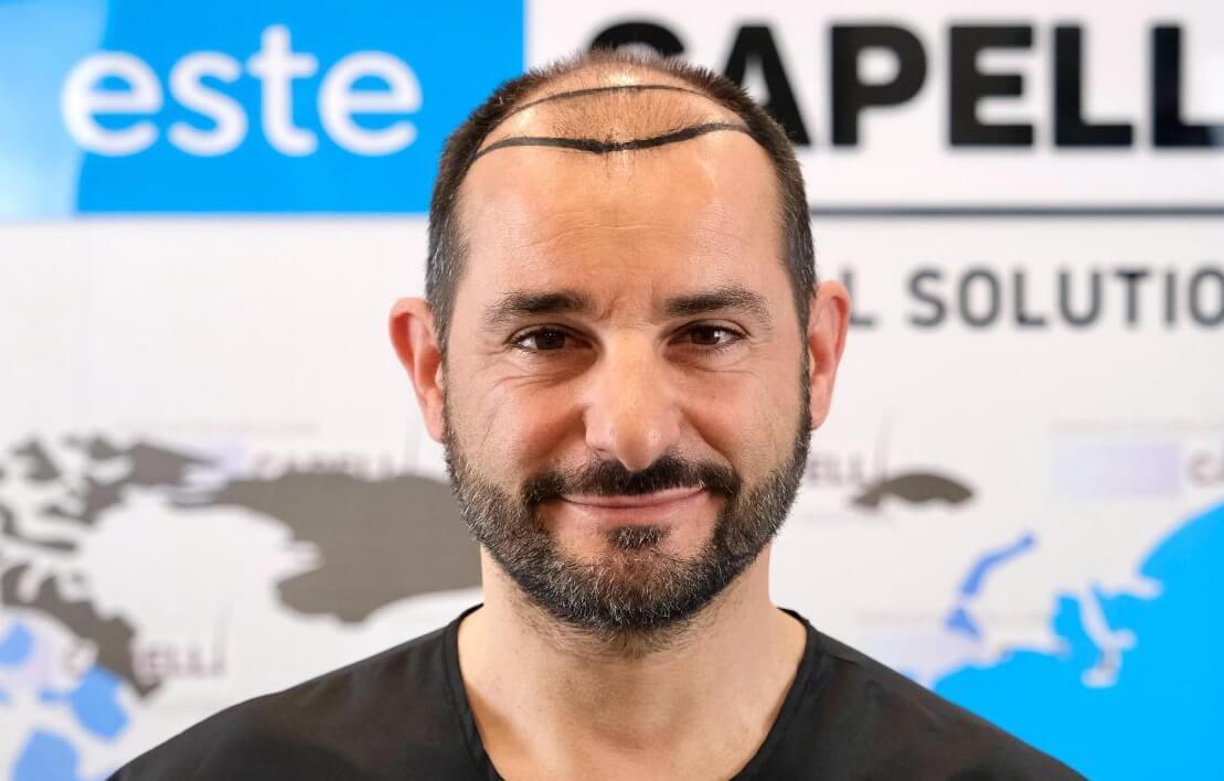 Before Treatment - Front