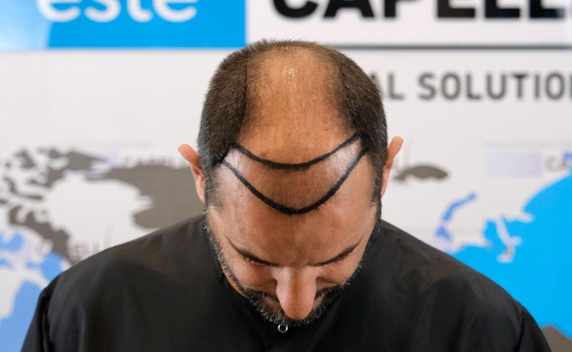 Before Treatment - Top