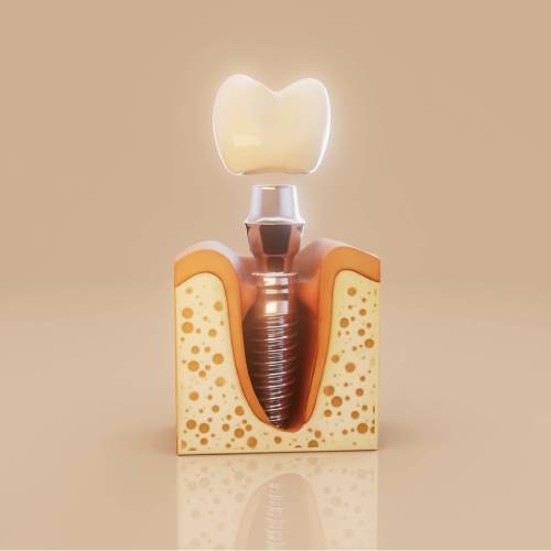 Placement Of The Prosthetic Structure