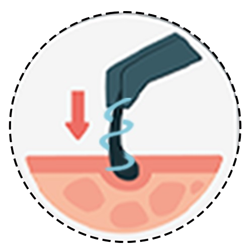 4. Transplantation of the Follicles