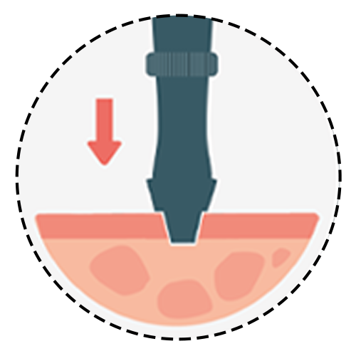 3. Preparation of the Transplant Area