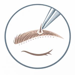 Implantation with the DHI Method