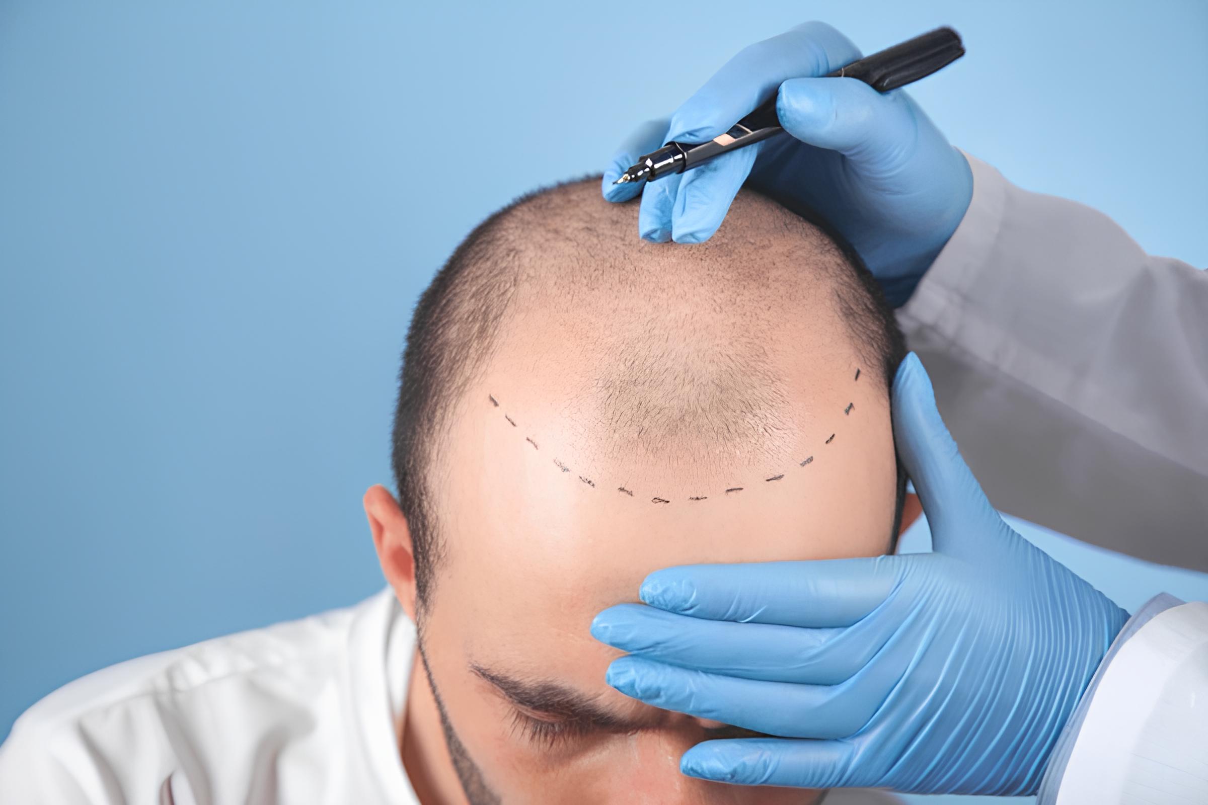 Pre-Hair Transplant Period