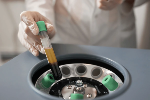 PRP (Platelet Rich Plasma)