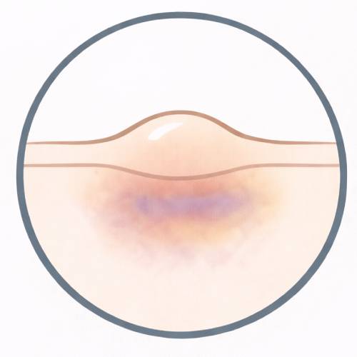 Bruising and Swelling