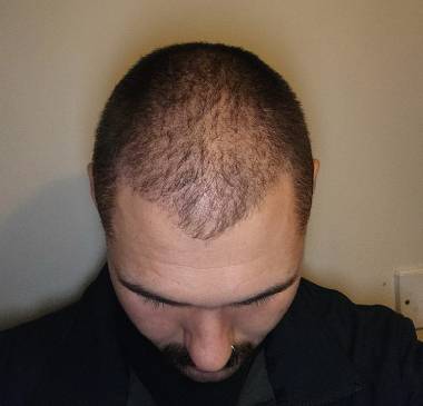 Full Healing Period: Healing Time