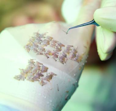 Collection of Grafts (Harvesting Follicles From the Donor Area) 