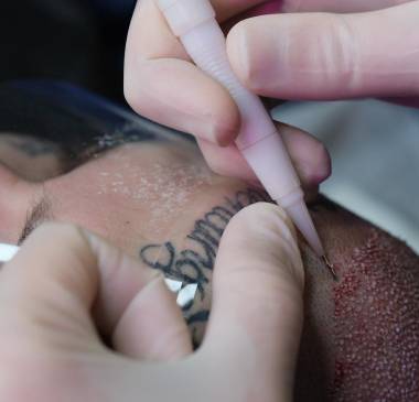 Hair Follicle Implantation (Implantation) 