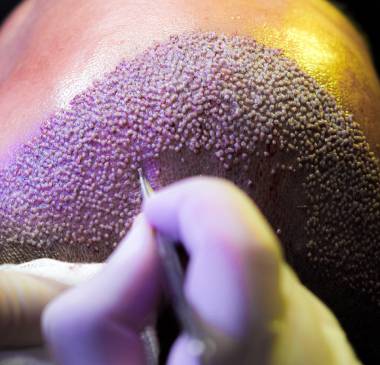 Hair Follicle Implantation