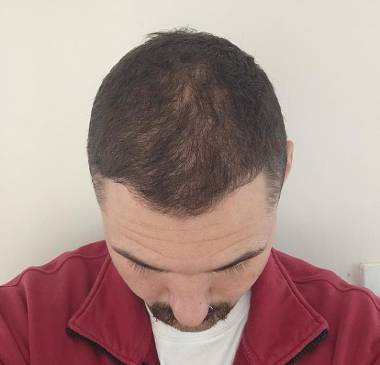 Hair Growth and Natural Appearance