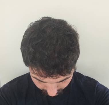 Healthy and Permanent Results with Estecapelli