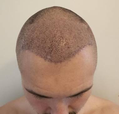 Initial Recovery Period: First Days and Weeks – Mild Redness and Swelling