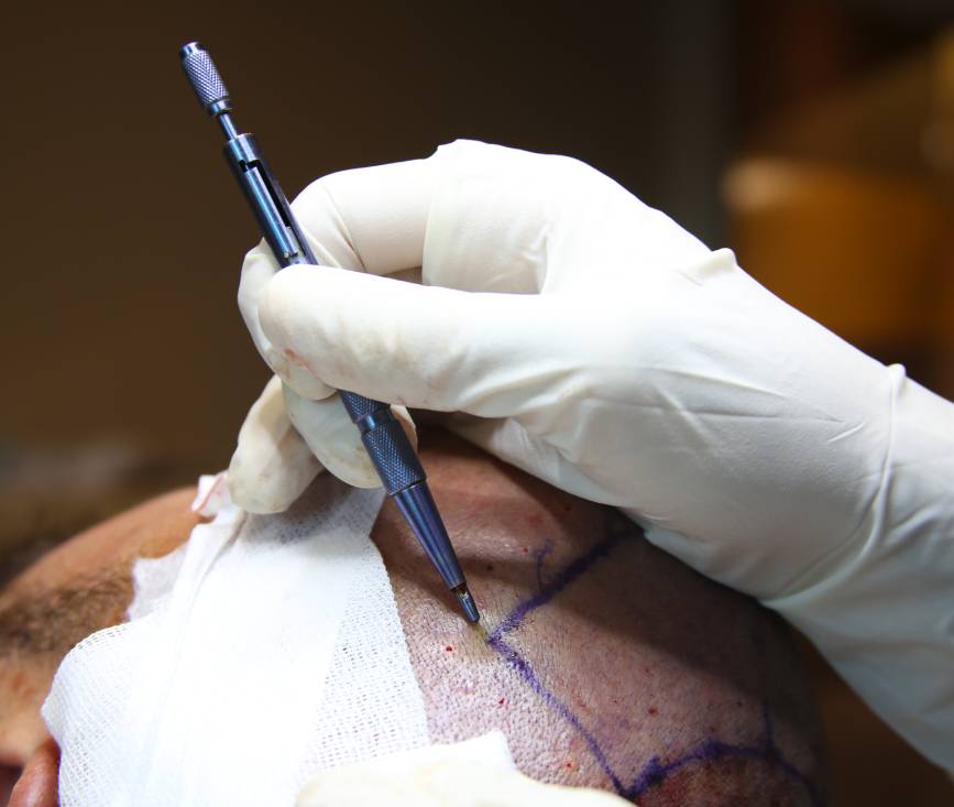 Étape 4: Application Du Sérum Aux Greffons Par Vapeur Froide