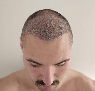 Scab Shedding Phase After Hair Transplantation