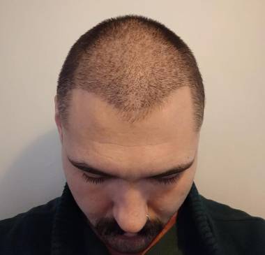 Shock Loss (Temporary Shedding)