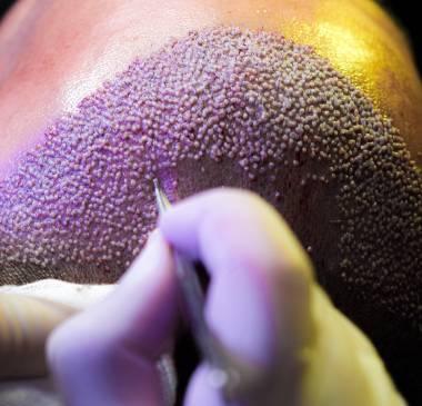 Stage 6: Graft Implantation