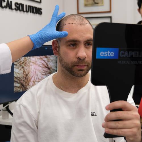 Personalized Hair Transplant Planning