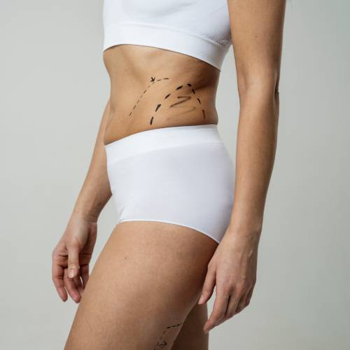 Liposuction + Abdominoplasty Combination