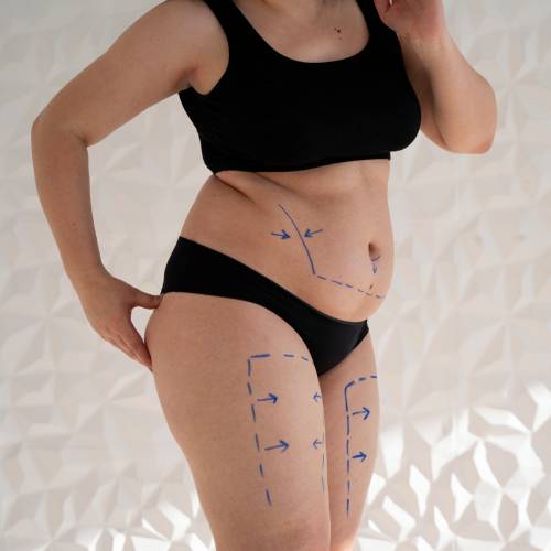 Full Abdominoplasty