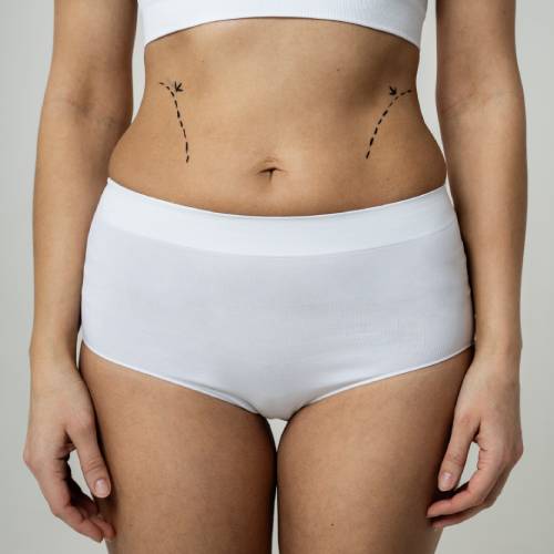 Mini Tummy Tuck
