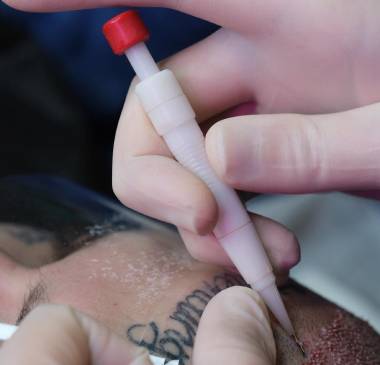 Stage 5: Implantation With Choi Pen