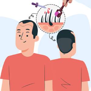 Stage 1: Microneedling and Nutrient Serum Application