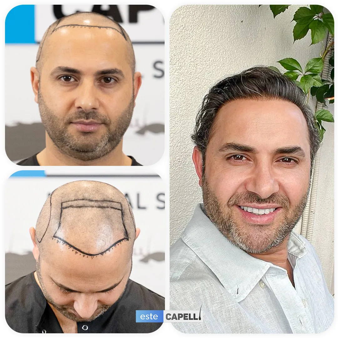 Before and after result