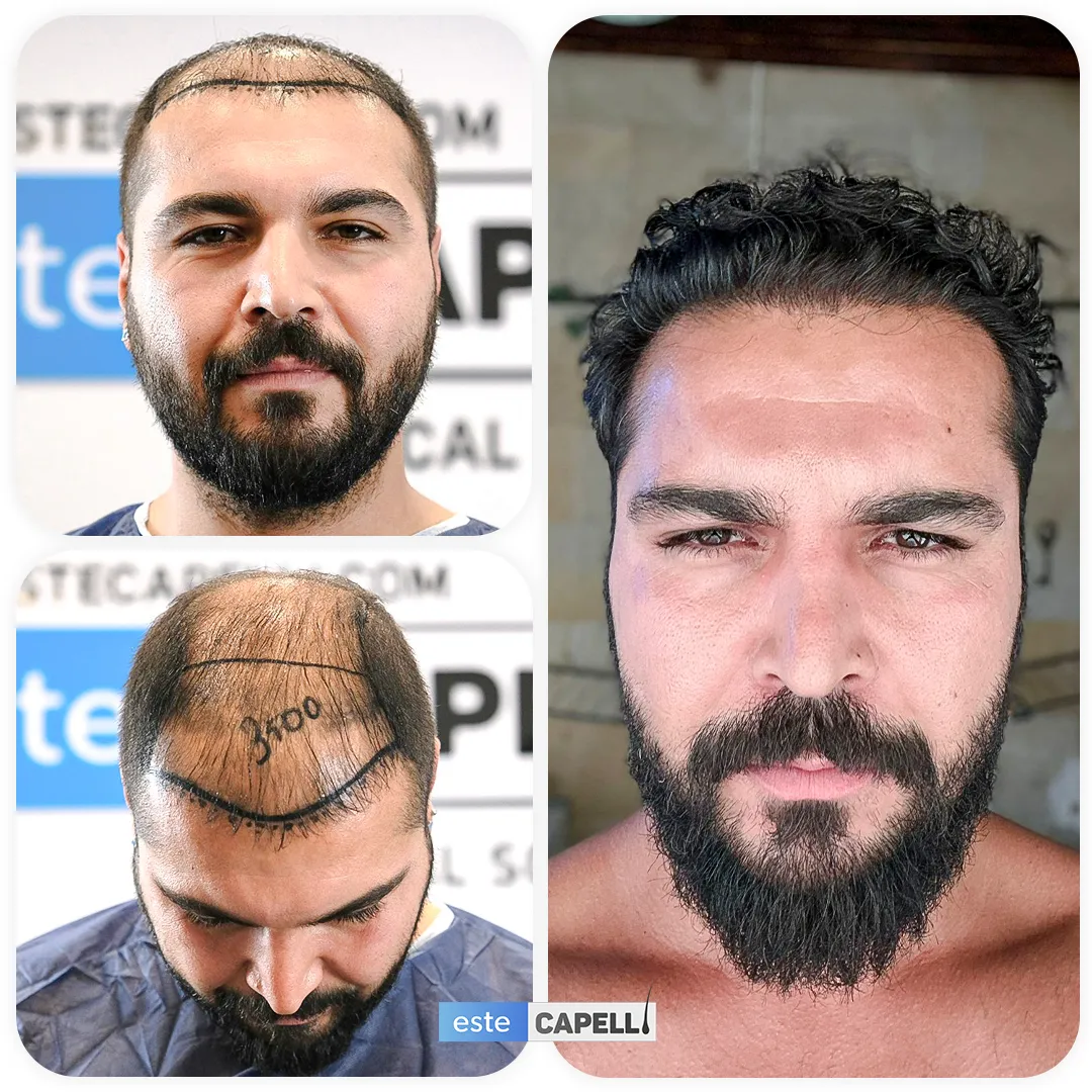 Before and after result