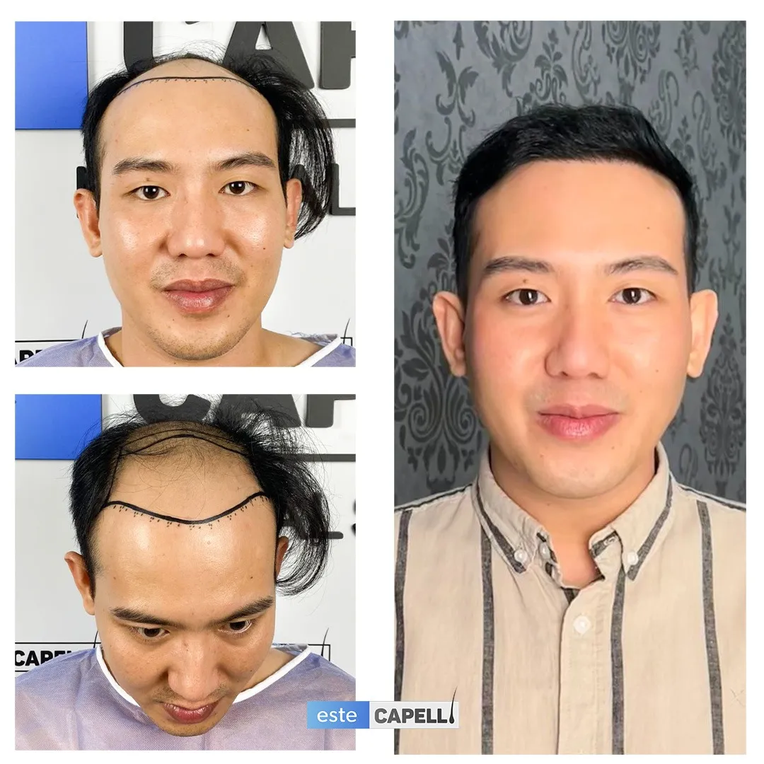 Before and after result