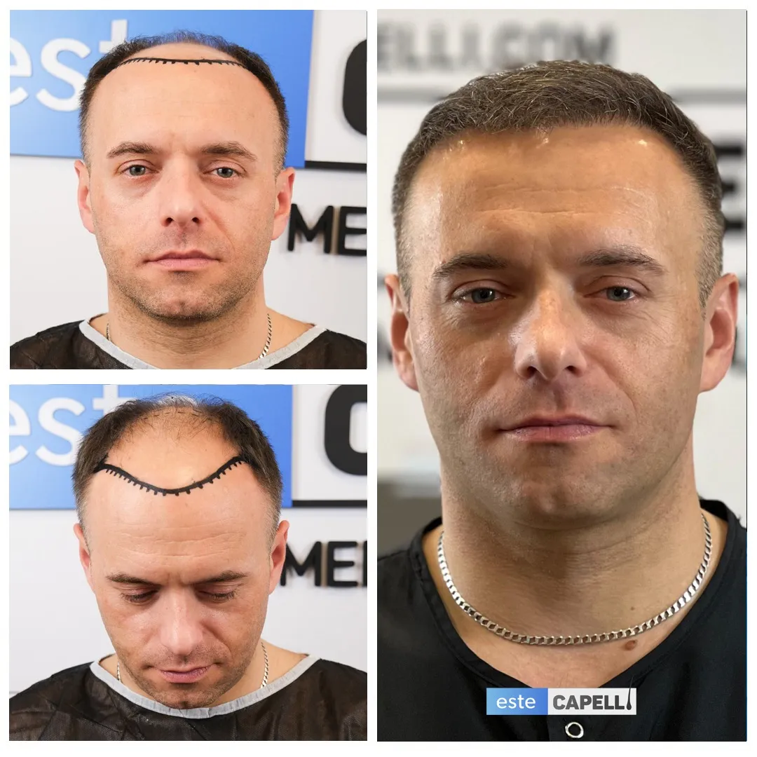 Before and after result