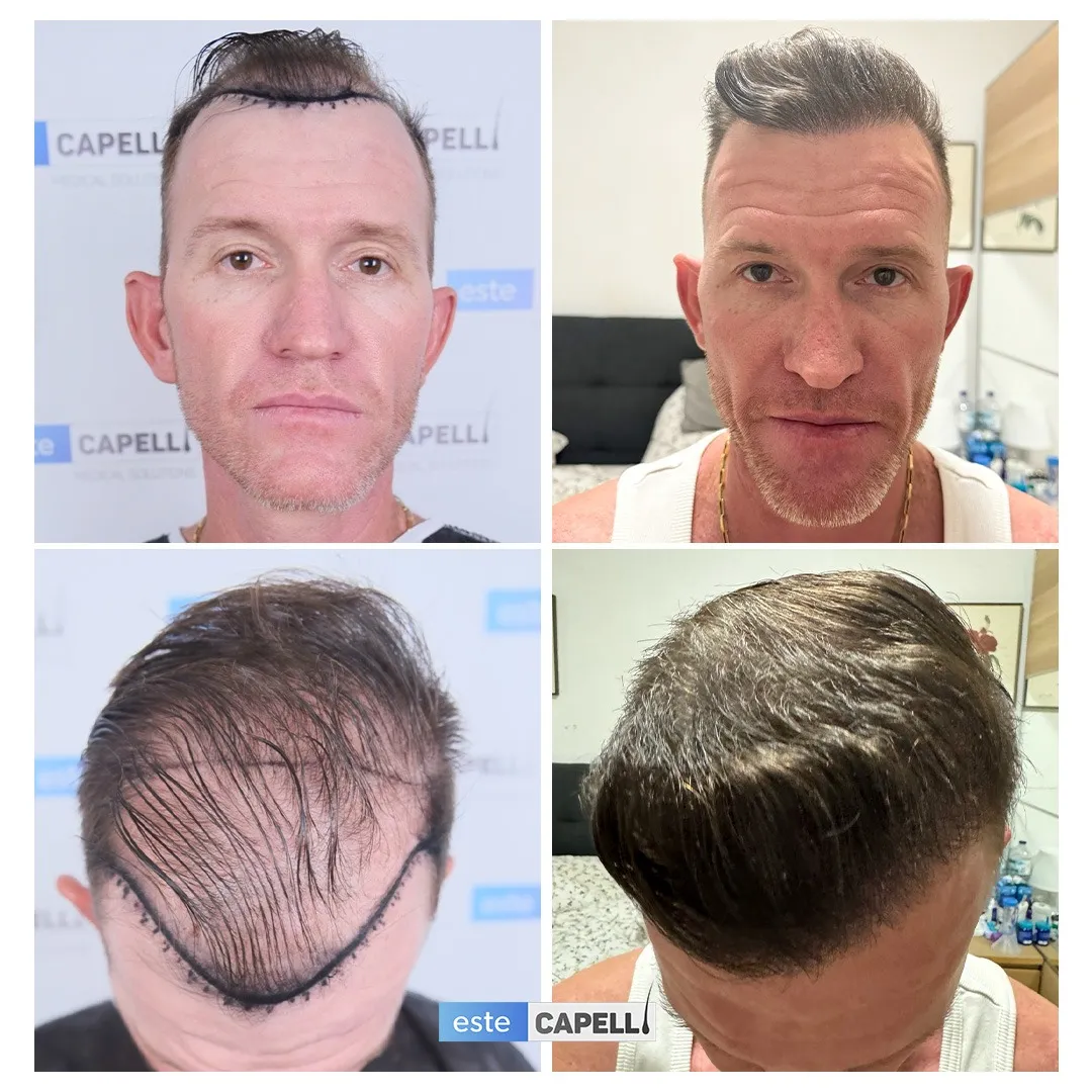 Before and after result