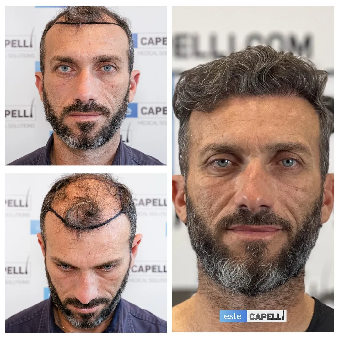 Before and after result