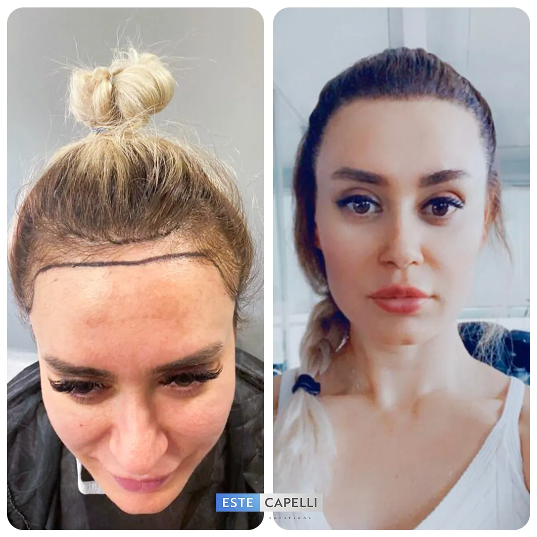 Before and after result