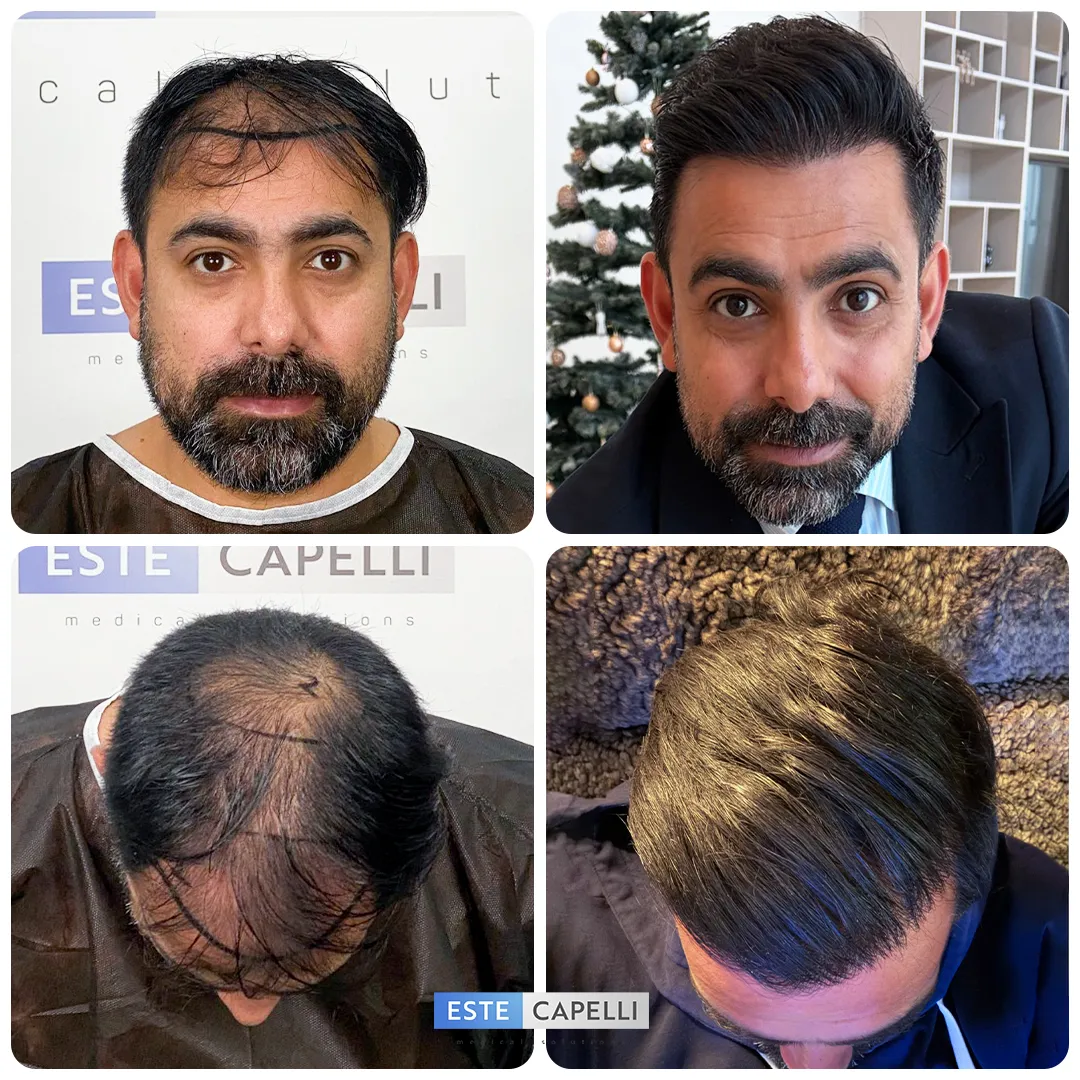 Before and after result