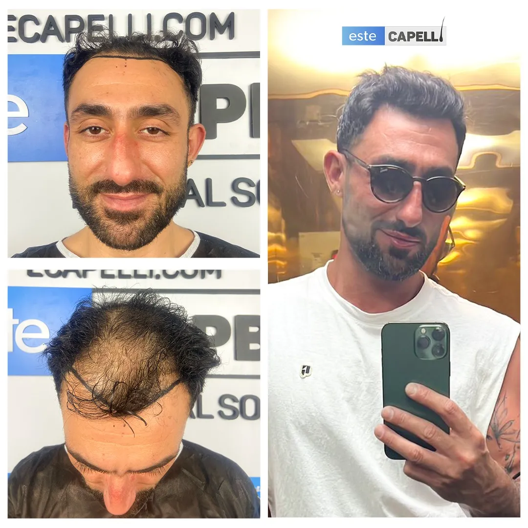 Before and after result